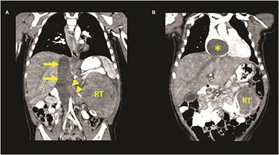 Case report: Urgent surgical management of pediatric clear cell sarcoma of the kidney with atrial obstruction